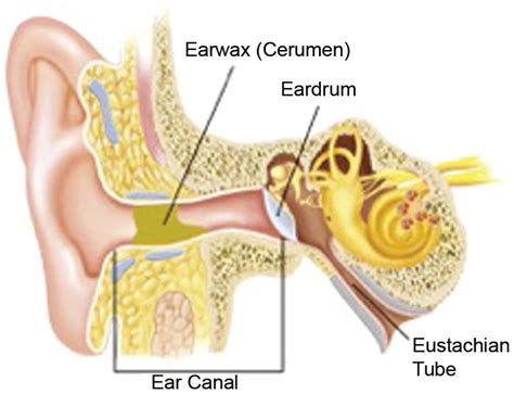 unable to test patient hearing due to impacted wax|does ear wax damage ears.